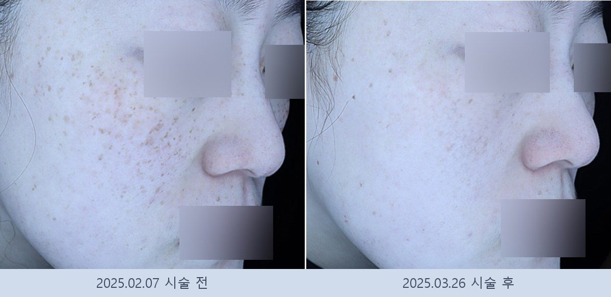 기미 잡티
